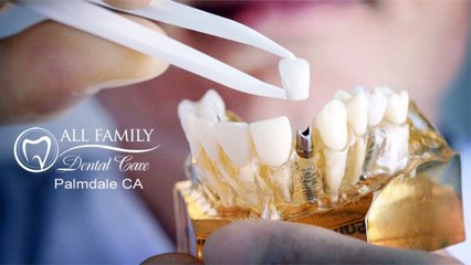 All Family Dental Care : Dental Implants in Palmdale, CA