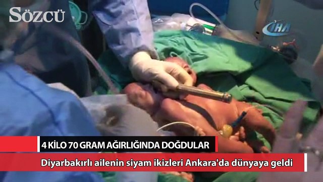 Diyarbakırlı ailenin siyam ikizleri Ankara'da dünyaya geldi
