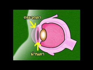 "ตะลุยโรงหมอ" เทป 26 .. ( ตอน "ต้อกระจก" )