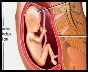 Volvulo infantil: Autopsia forense