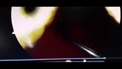 Insektin që iu fut në kafkë, ia nxorën nga hunda