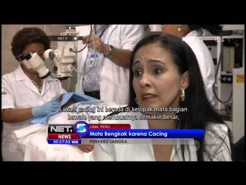 Aksi Dramatis Dokter yang Mengeluarkan Cacing dari dalam Mata Pasien - NET5