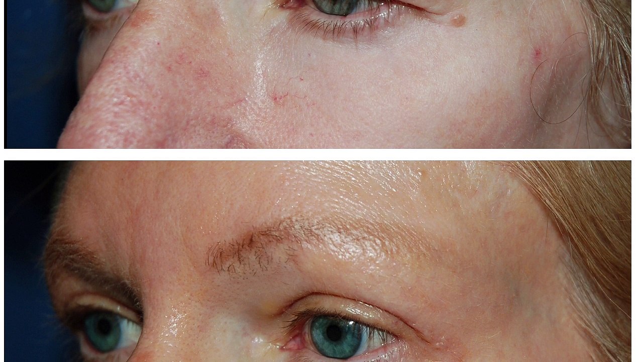 Eyelid Surgery in Seattle Washington