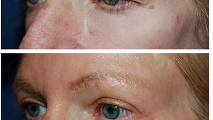 Eyelid Surgery in Seattle Washington