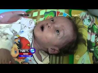 Download Video: Waspada Gizi Buruk Menyerang Anak Anak - NET5