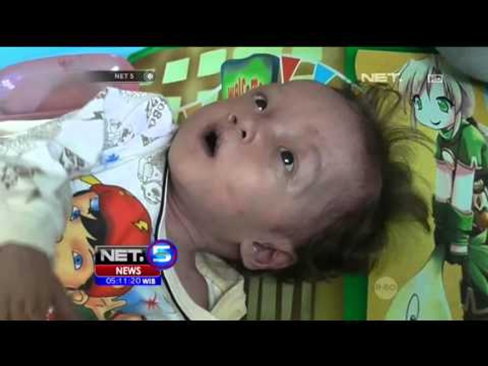 Waspada Gizi Buruk Menyerang Anak Anak - NET5