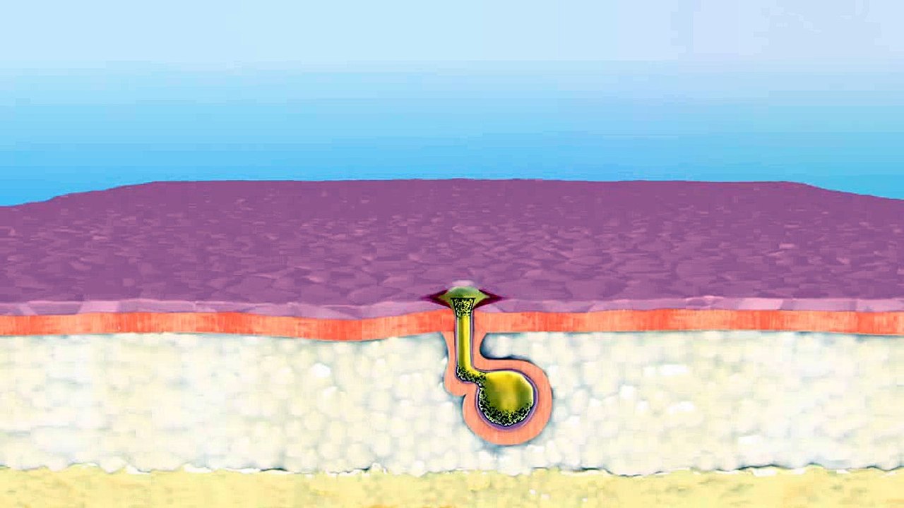 ISOLAZ® System - SOLTA MEDICAL® (A Division of Valeant Aesthetics) - Treatment