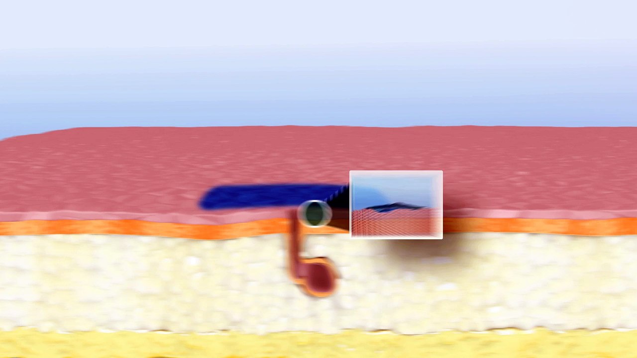 ISOLAZ® System Profusion MOA Video - SOLTA MEDICAL® (A Division of Valeant Aesthetics)