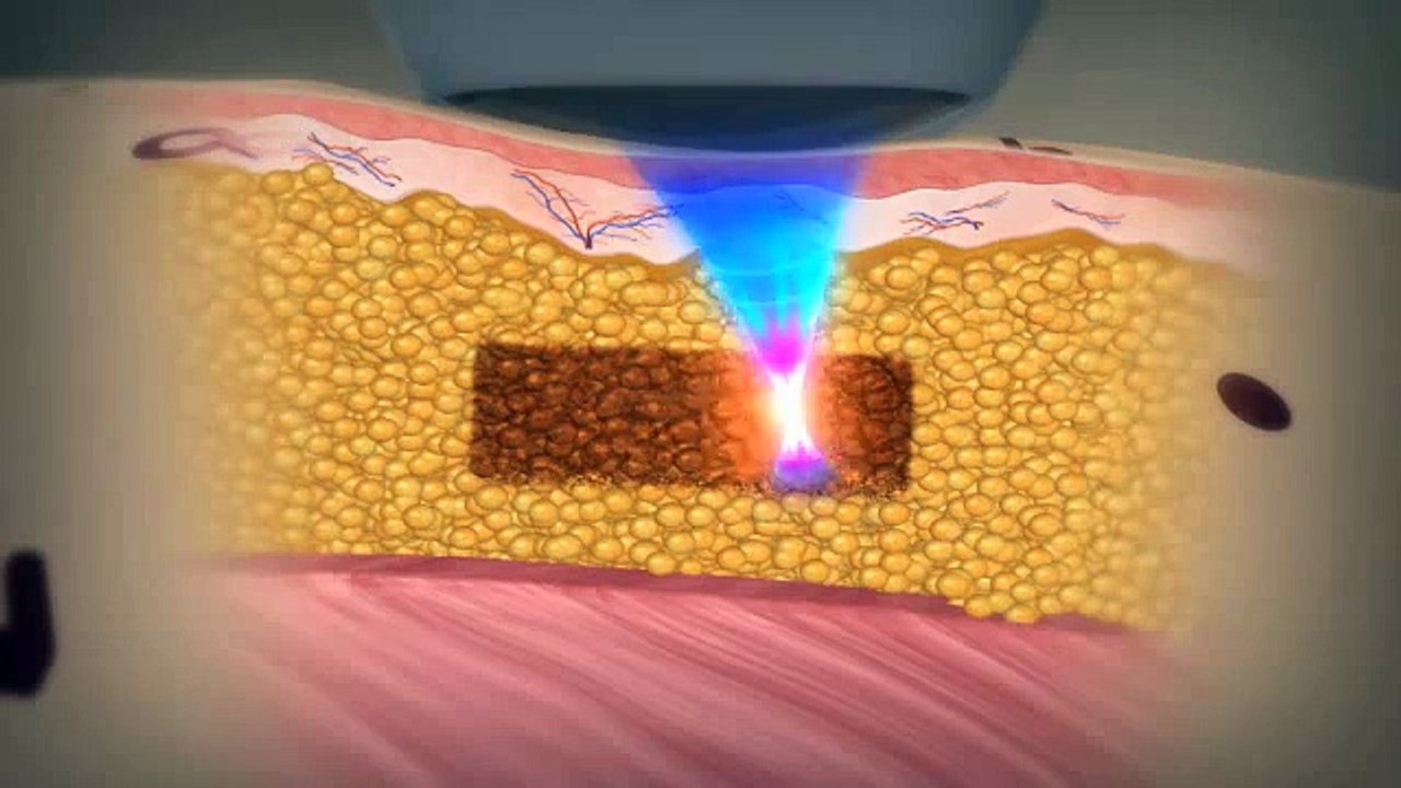 Liposonix | Fat Reduction - SOLTA MEDICAL® (A Division of Valeant Aesthetics)