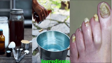 1. This easy recipe of 2 ingredients will remove nail fungus forever