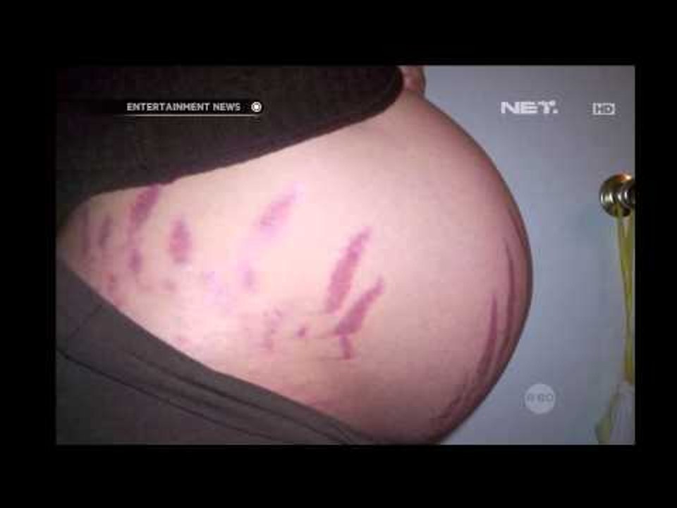 Riset tentang Stretch Mark