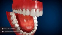 Jaw Surgery for Teeth Alignment - Fixing Jaw Braces