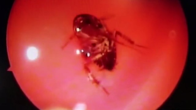 Des médecins retirent un cafard du nez d'une patiente