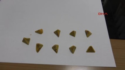 Şanlıurfa Safra Kesesinden Çıkan Piramit Şeklindeki Taşlar Şaşırttı