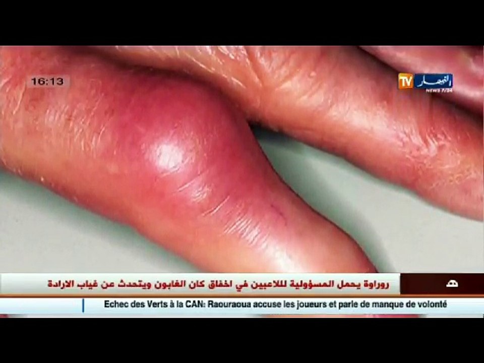 3 دقائق صحة  تورم الأصابع في فصل الشتاء  عضة ال...