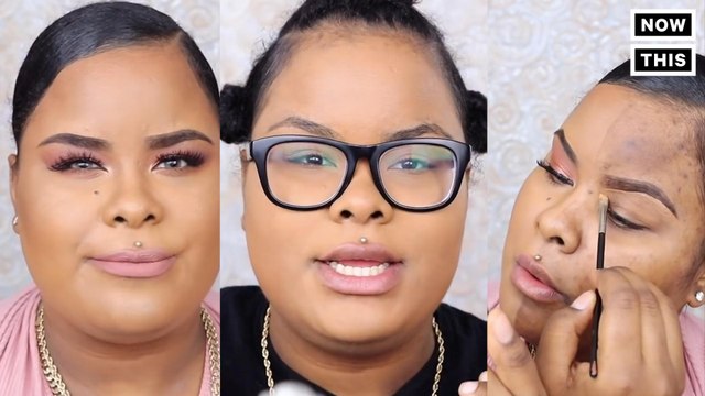 YouTuber Overcomes Acne Scars