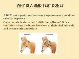 What Is Bone Mineral Density? Dr Vivek Baliga Presentation- Patient Information Video