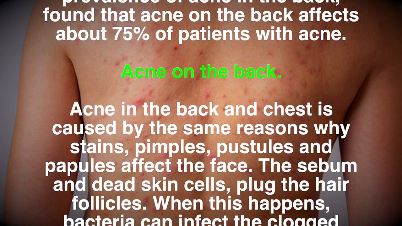 38. Acne in the back and chest causes and natural treatments