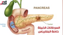 فيديو معلوماتى.. اكتشفها مبكرًا.. 5 أمراض خطيرة بدون أعراض