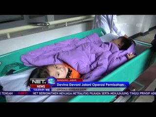 Balita Kembar Siam Jalani Operasi Pemisahan Tubuh  NET12