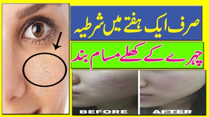 Open Pores Treatment In Urdu | Khulay Masaam Ka Garelu Ilaaj