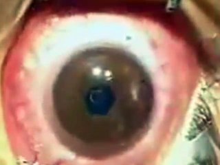 Did you see the Lasik eye surgery