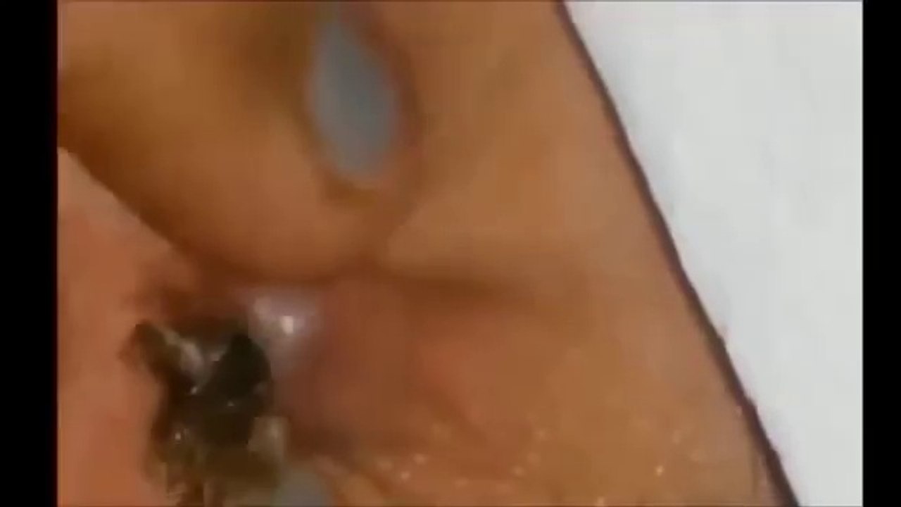 ponto negro enorme de menino de 12 anos