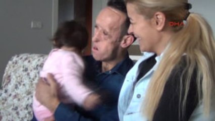 Bursa Yüz Nakli Olan Recep Sert'in Kızı Hira Yürümeye Başladı