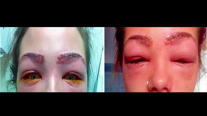 cuidado! Adolescente quase fica cega , após usar tinta para sobrancelhas.