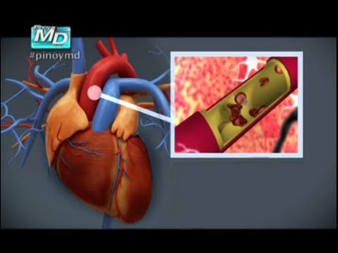 Most common cardiovascular stroke risk factors | Pinoy MD