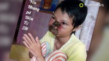 Flesh eating fungus: Vietnamese woman’s face completely destroyed by fungus - TomoNews