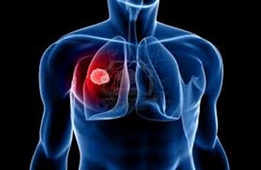 Ohio Mesothelioma Lawyer - Mesothelioma Attorney in Ohio Review