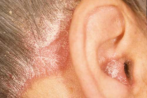 Psoriasis & Detox