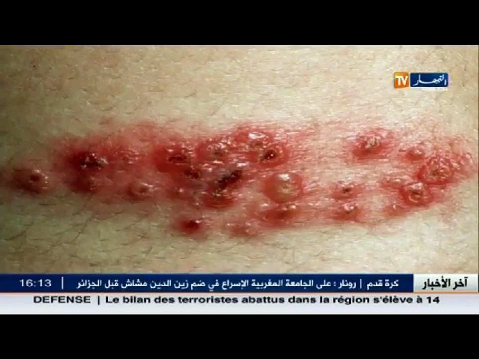 3 دقائق صحة  أمراض الجلد ..  جدري الماء  مسببات...