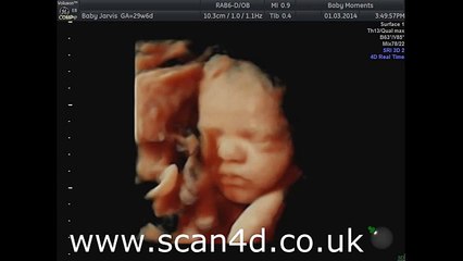 4d Pregnancy scan