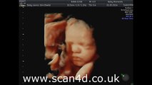4d Pregnancy scan