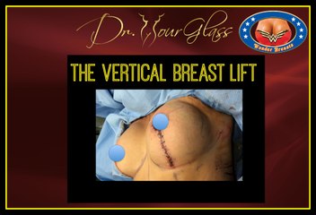 The Vertical Breast Lift