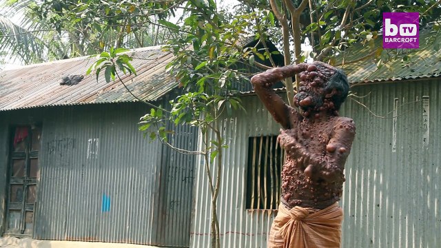 Un homme vit avec un corps recouvert de tumeurs