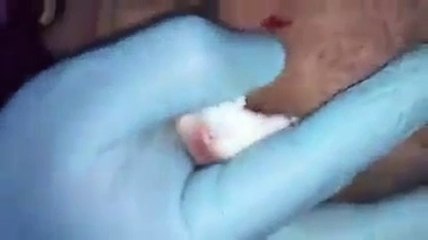 Beginilah Kondisi Saat Susuk Di Cabut Di Kepala