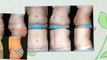 Tummy Tuck by Jeff Healy, MD in Aiea, Hawaii