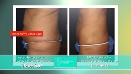 Smartlipo Before & After Chicago IL | Laser Liposuction South Loop