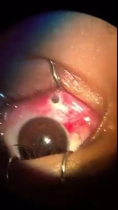 Pencil on child eyes operation