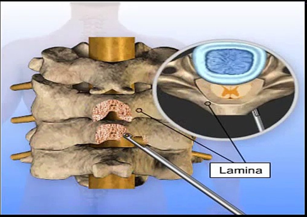 Posterior Cervical Laminectomy and Fusion Surgery Animation - video