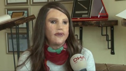 Türk Doktorun Yüzü Yanan Hastanın Dokusundan Geliştirdiği Tedavi Tıp Literatürüne Girdi