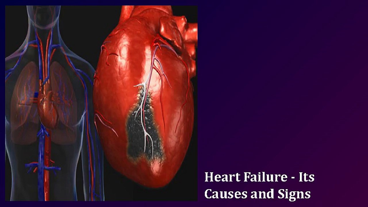 Heart Failure - Its Causes and Signs