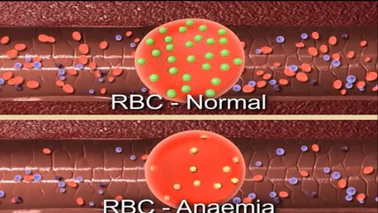 Anaemia - ANIMATED MEDICAL DICTIONARY