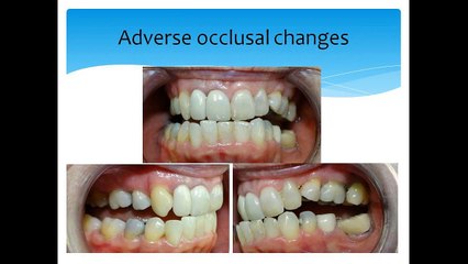 Sleep Apnea Presentation by John B Harrison DDS, MSc