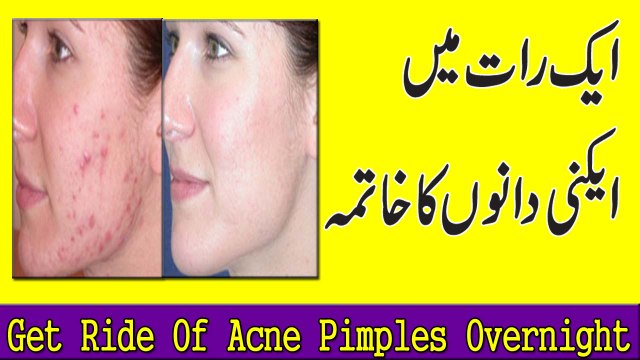 Remove Pimples Overnight Chehre K Danon Ka Ilaaj