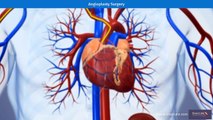 Visual Guide to Angioplasty & Stenting | Animated Video | SurgeryLog