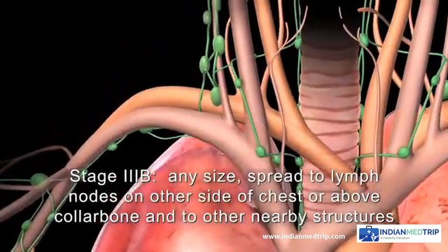 Lung Cancer: What Are the Symptoms & Treatment Options?